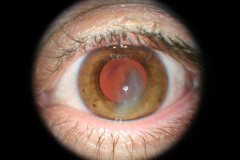 Corneal Hydrops early stages